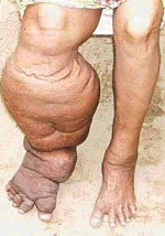 බළපිටියේ බරවා-ඩෙංගු හිස ඔසවයි..?
