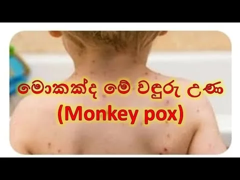 වඳුරු උණ ආසාදිතයන්ගේ මරණ ඉහළට